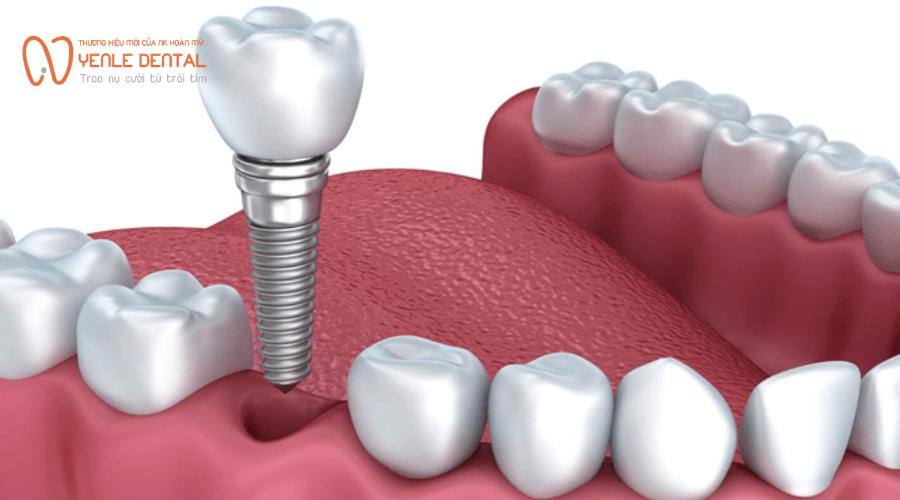 Nhược điểm trồng răng Implant
